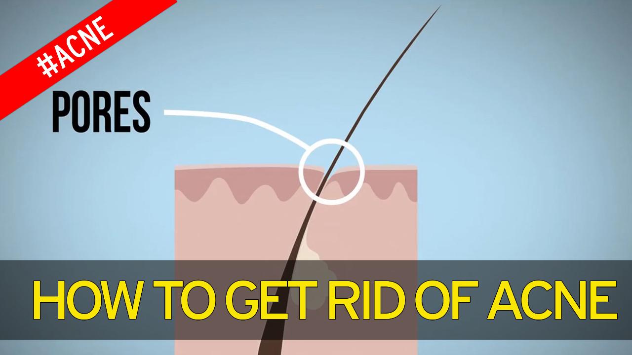 4 Natural ways to get rid of pimples as fast as possible